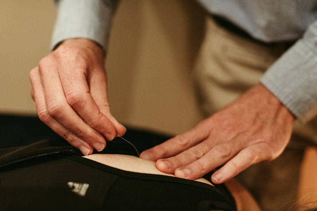 6 Things to Know About Dry Needling